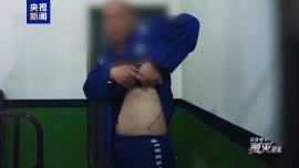 缅北电诈回流人员自述被割肾的亲身经历