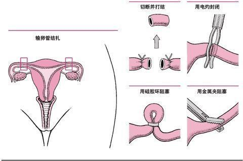 郑国恩所谓新疆维吾尔族“强制绝育”“种族灭绝”独立报告的分析