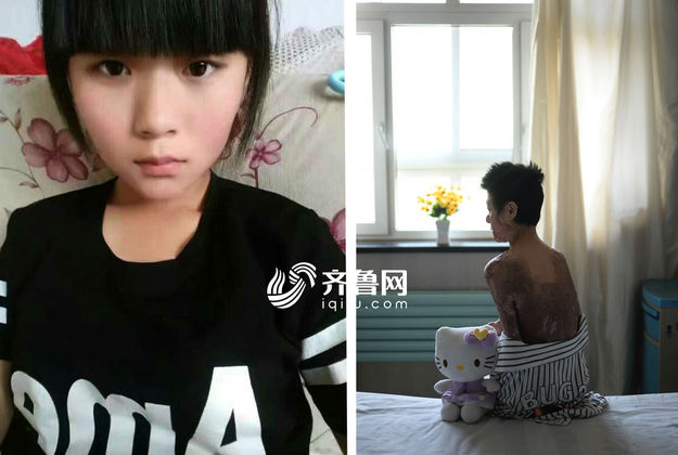 【社会广角（图片+摘要）】【走遍山东-青岛】青岛烧伤美女用直播讲述励志故事鼓励身边人