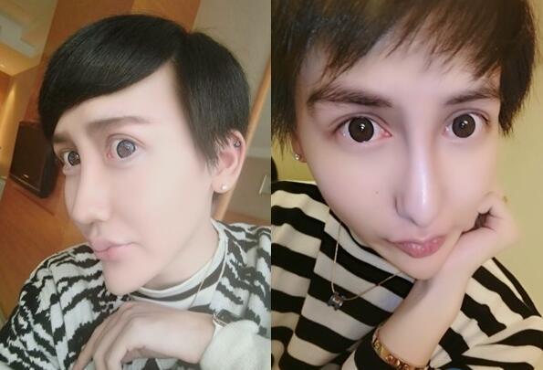 蛇精男打玻尿酸失败 哭喊：这样怎么出门见人！