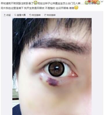 蛇精男打玻尿酸失败 哭喊：这样怎么出门见人！