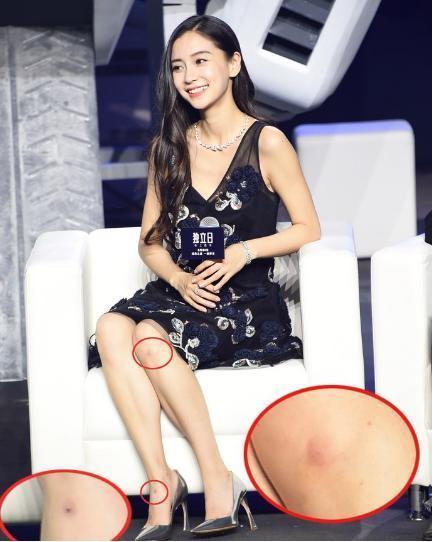 baby腿上现多处伤痕 baby的下巴整容了吗？