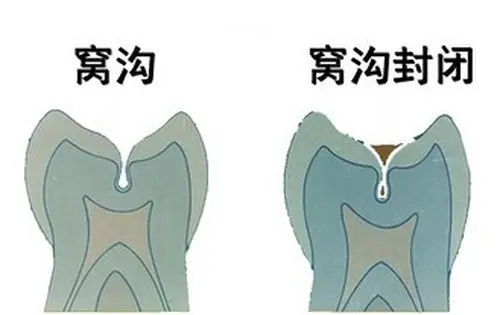 全国爱牙日|青少年口腔健康，一篇详解！_fororder_窝沟封闭