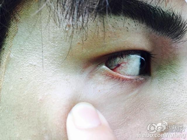 杨旭文《射雕》伤痕曝光 网友：满满都是心疼_娱乐_腾讯网