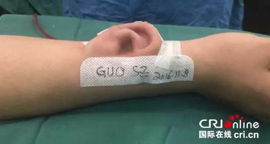 耳朵“活”了 西安交大一附院前臂再造耳移植成功