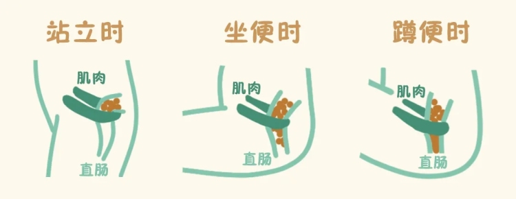 真心建议：如厕方式这样选，更健康！_fororder_3_副本